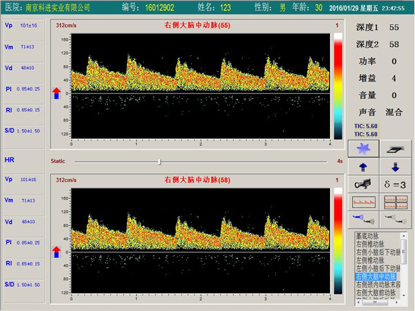 經(jīng)顱多普勒單通道，雙深度界面