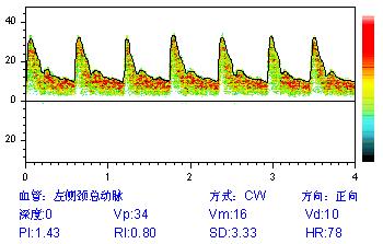 經(jīng)顱多普勒報告中間頻譜圖含義.jpg