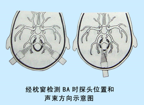 04經(jīng)枕窗檢測BA時(shí)探頭位置和聲束方向示意圖.jpg