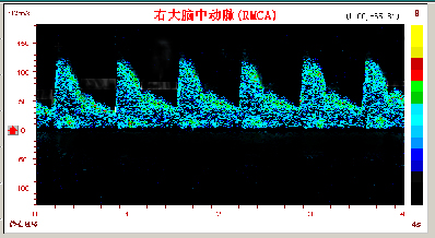 超聲經(jīng)顱多普勒腦動(dòng)脈硬化頻譜圖.jpg