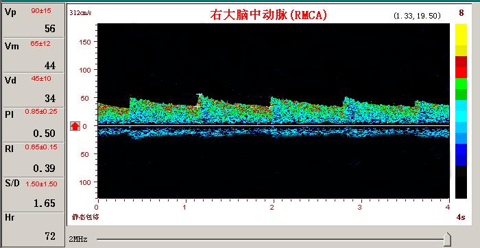 超聲經(jīng)顱多普勒腦血管擴(kuò)張頻譜圖.jpg