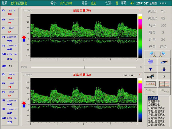 超聲經(jīng)顱多普勒血流分析儀雙窗口（雙通道或雙深度）檢測界面.jpg