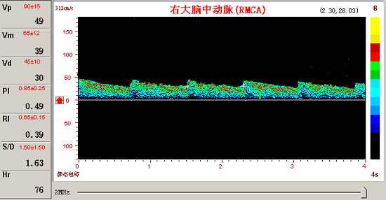 KJ系列超聲經(jīng)顱多普勒腦動脈瘤頻譜圖