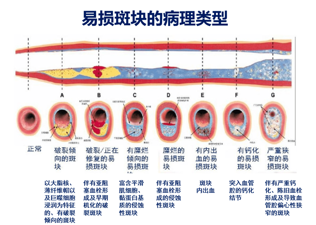 易損斑塊是缺血性卒中發(fā)生的獨(dú)立危險(xiǎn)因素