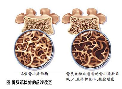 正常與骨質(zhì)健康問題骨密度對比